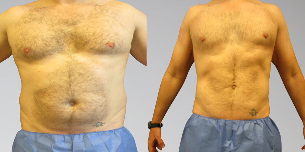 Male Liposuction Before & Afters Sono Bello Results