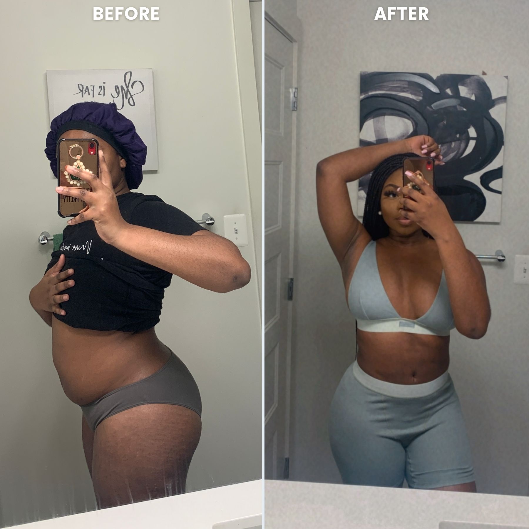 I Tried Laser Liposuction — Before and After Laser Liposuction