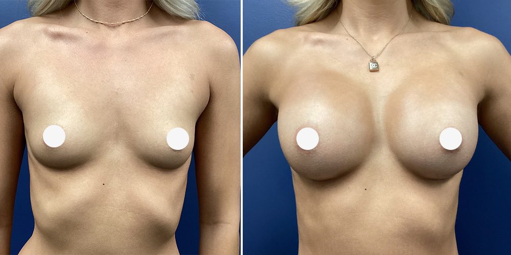 Sono Bello breast augmentation before and after