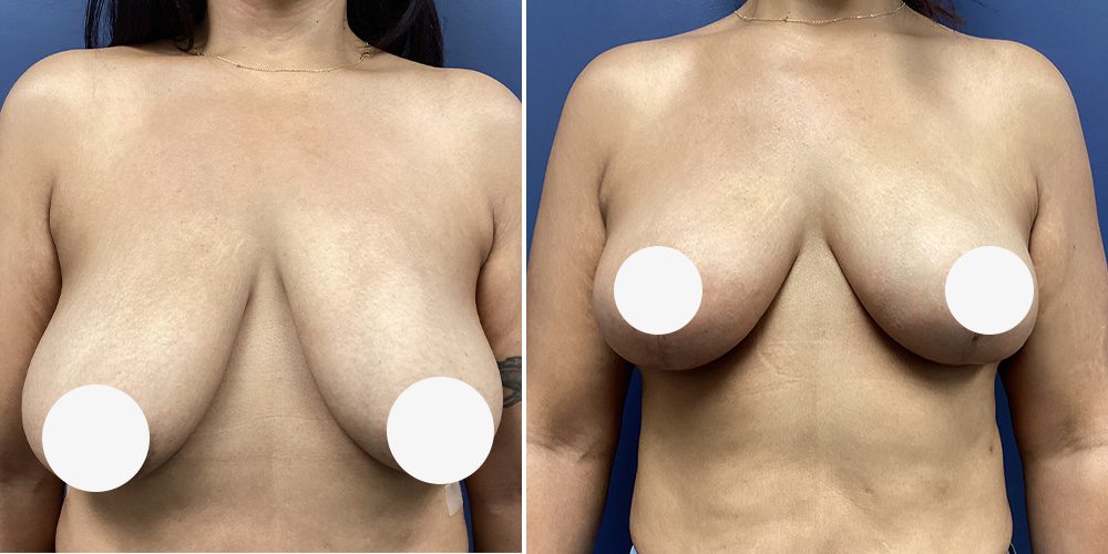 Sono Bello Contour breast enhancement before and after photo