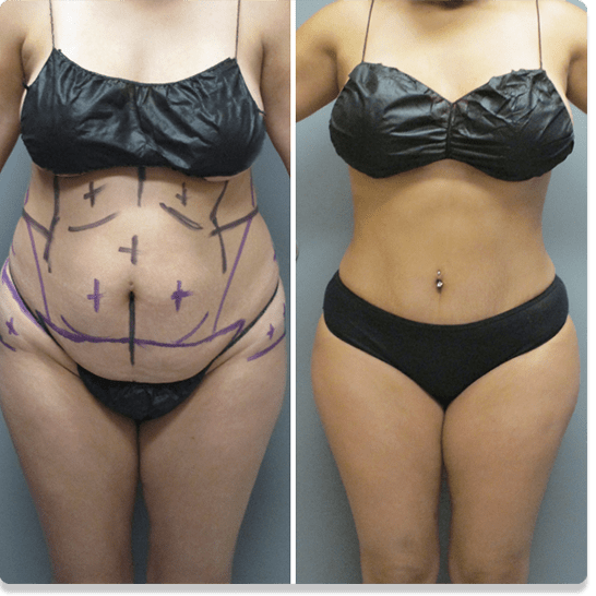 How Much is Laser Liposuction at Sono Bello?